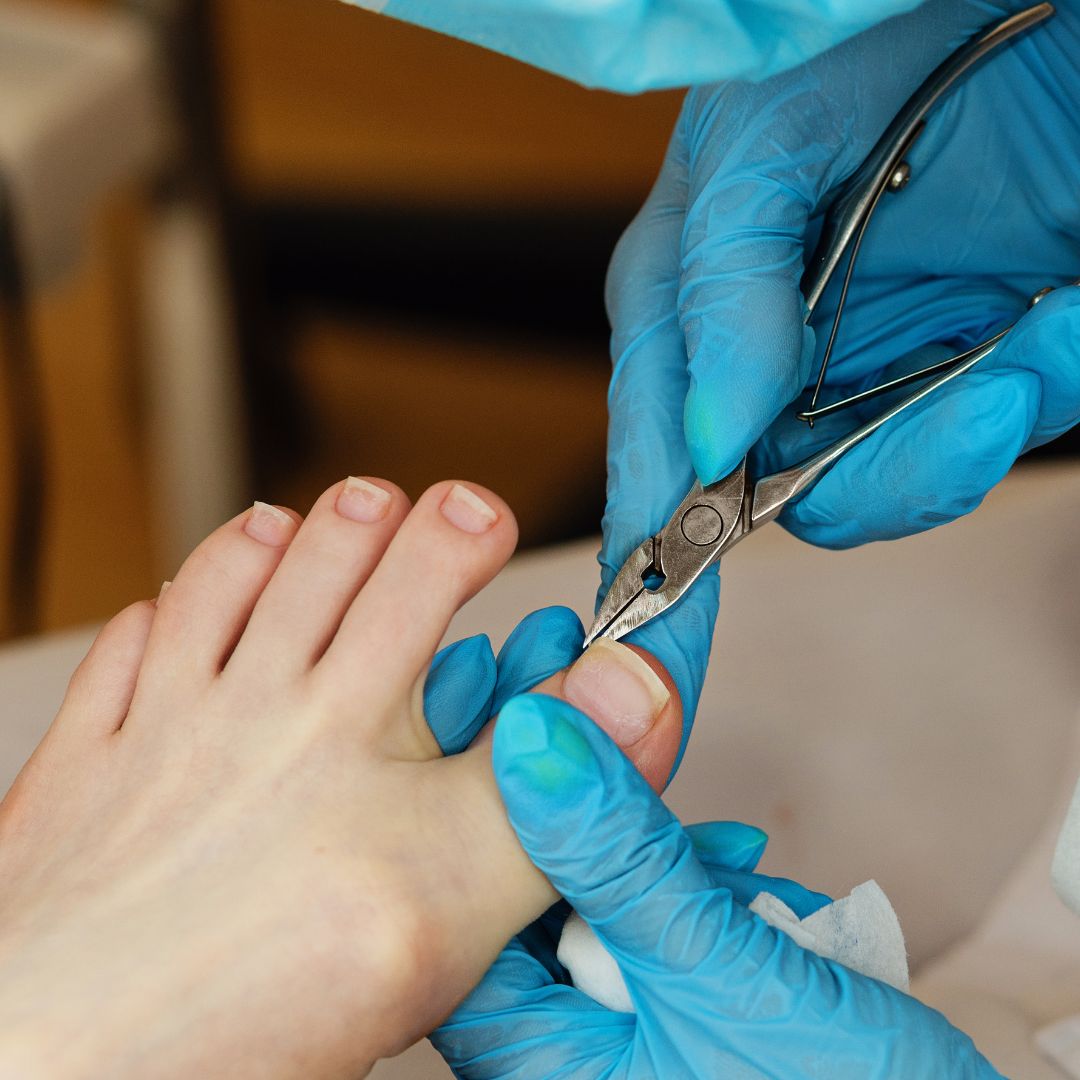 Aleesha's Advanced Footcare - Services - Ingrown Nails and Warts